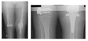 femoral and tibial 3 femoral and tibial 3