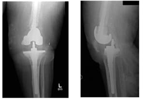 femoral and tibial 4 femoral and tibial 4
