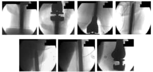 femoral and tibial 6 femoral and tibial 6