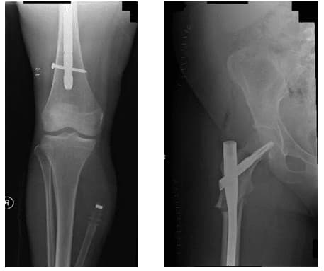 femur-oblique 2 femur oblique 2