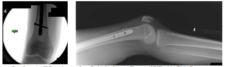 femur oblique 3 femur oblique 3