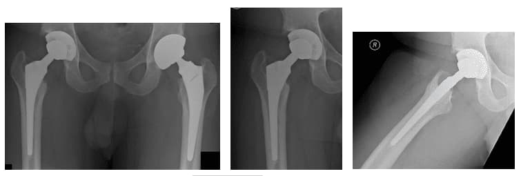 hip replacement 1 hip replacement 1