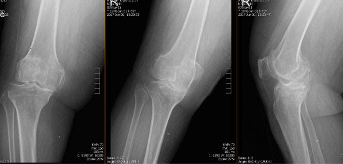 Étude de cas sur l’arthroplastie totale du genou droit 1