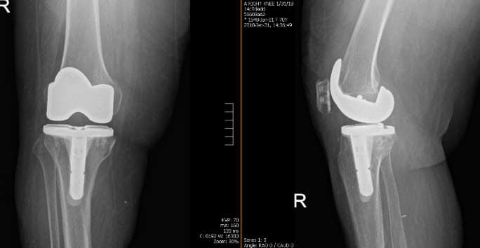 Étude de cas sur l’arthroplastie totale du genou droit 2 Arthroplastie totale du genou droit