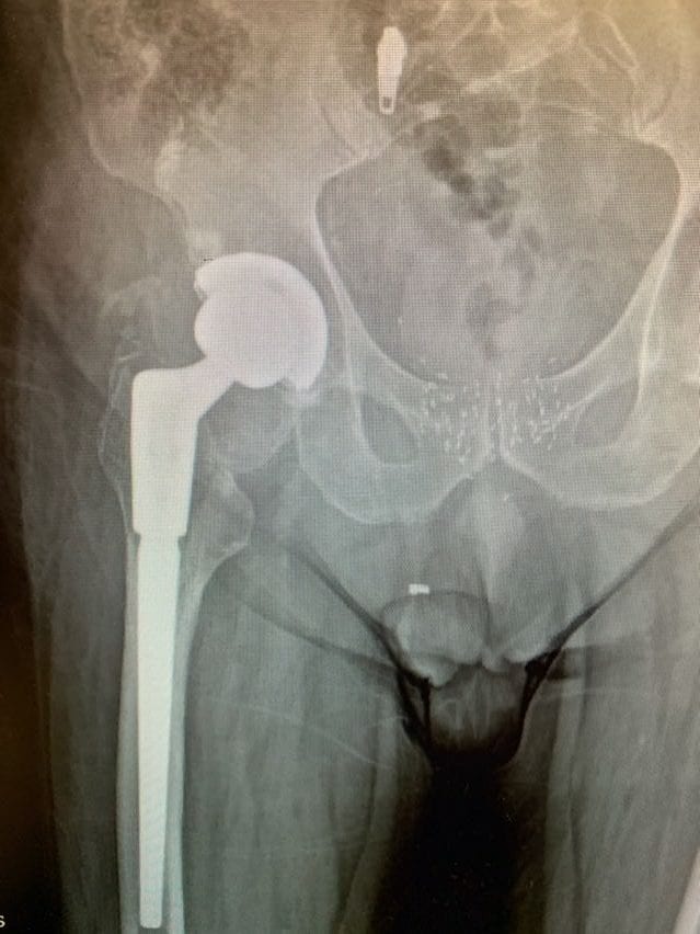 JF – Hip Replacement Revision Surgery | NY, USA