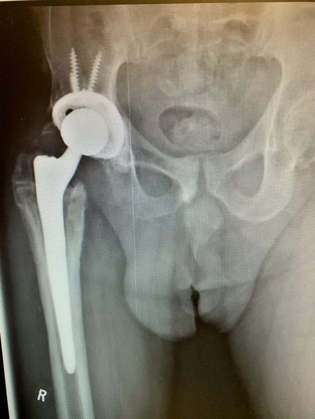 Case Study: LR – Revision Hip Replacement