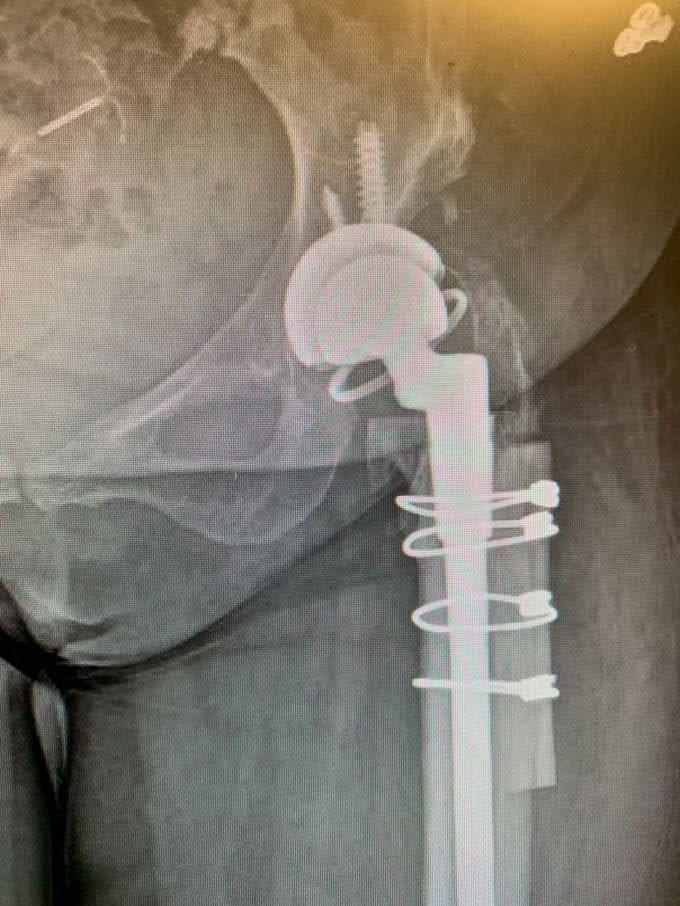 Case Study: WM – Revision Hip Replacement